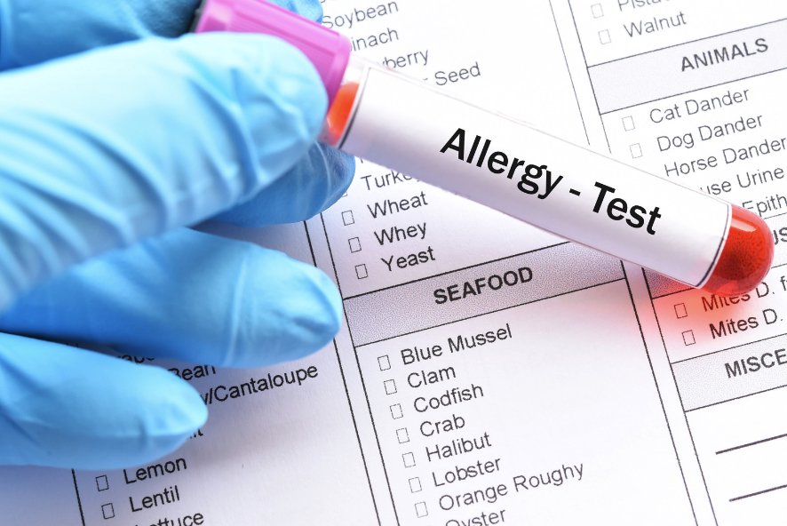 How to Prepare for an Allergy Test and Uncover Your Hidden Allergies