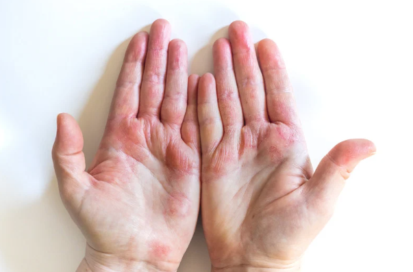 Understanding Eczema: How an Allergist in Irvine Can Help